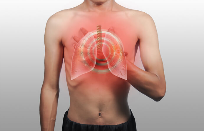 Mengetahui tentang Acute Respiratory Distress Syndrome